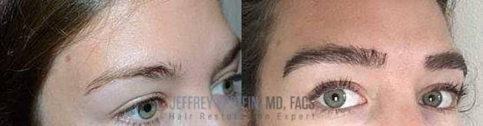 Before & After Eyebrow Transplant Case 170 View 2 View in Miami, FL
