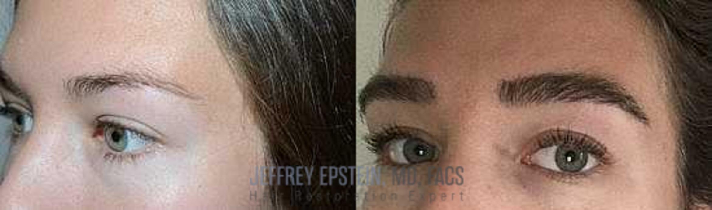 Before & After Eyebrow Transplant Case 170 View 3 View in Miami, FL