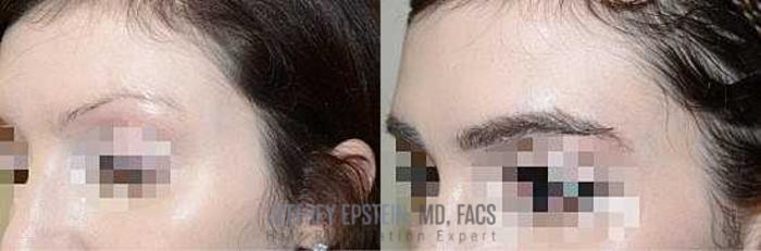 Before & After Eyebrow Transplant Case 195 View 3 View in Miami, FL