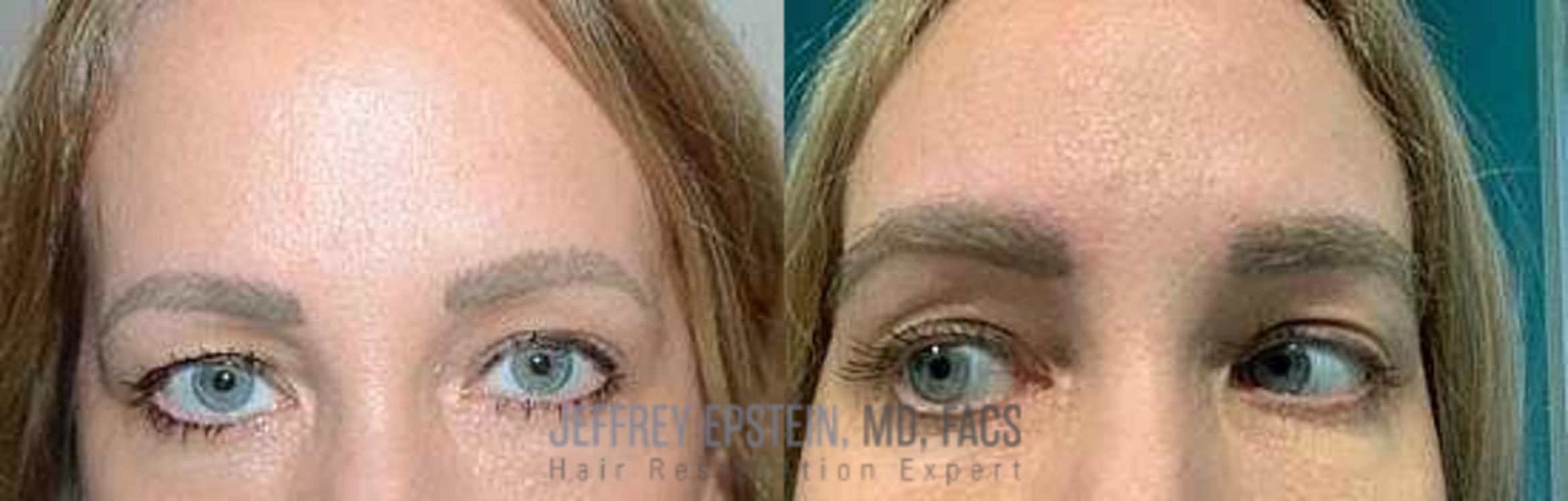 Before & After Eyebrow Transplant Case 296 View 1 View in Miami, FL