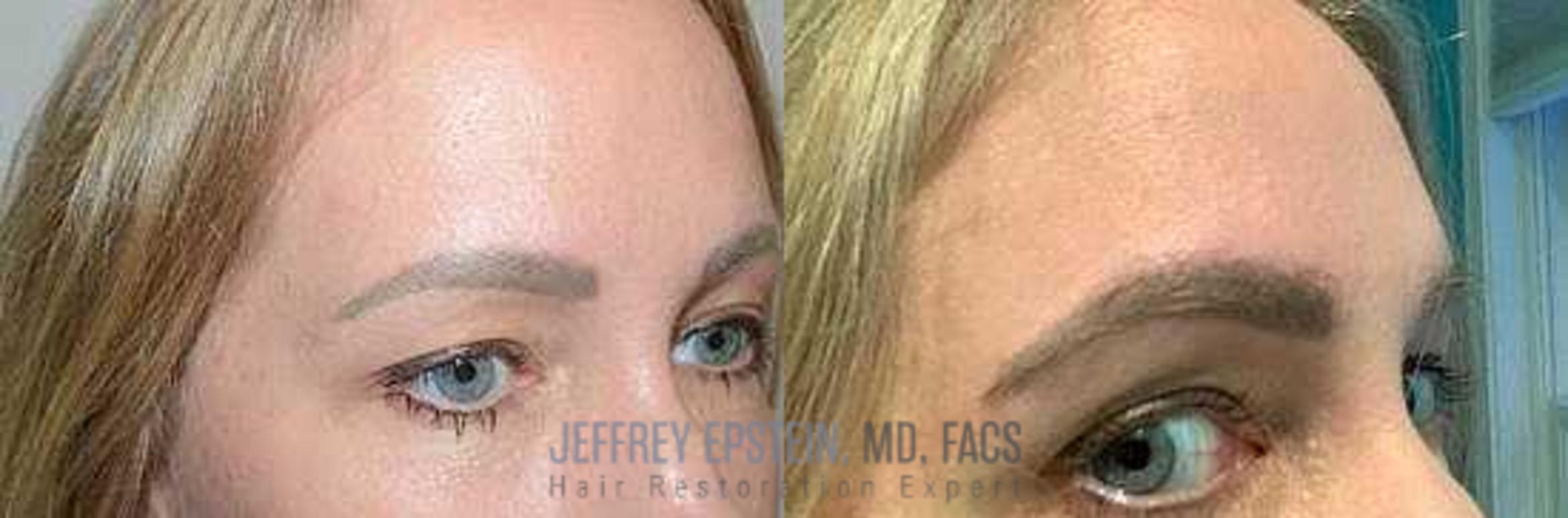 Before & After Eyebrow Transplant Case 296 View 2 View in Miami, FL