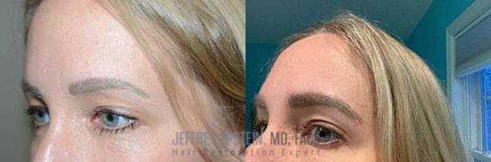 Before & After Eyebrow Transplant Case 296 View 3 View in Miami, FL