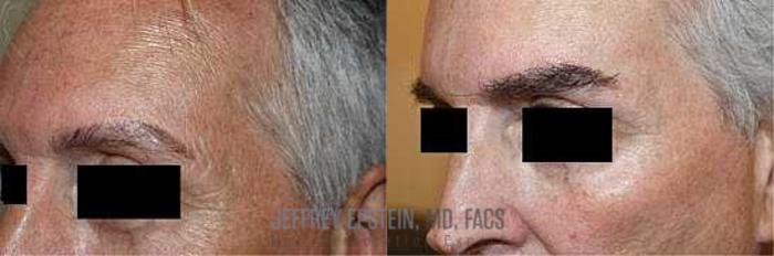 Before & After Eyebrow Transplant Case 298 View 1 View in Miami, FL