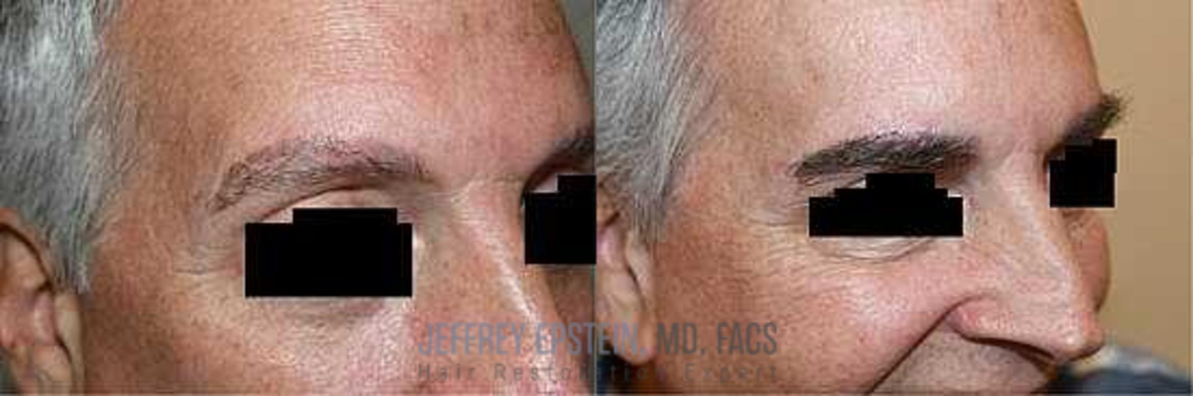 Before & After Eyebrow Transplant Case 298 View 2 View in Miami, FL
