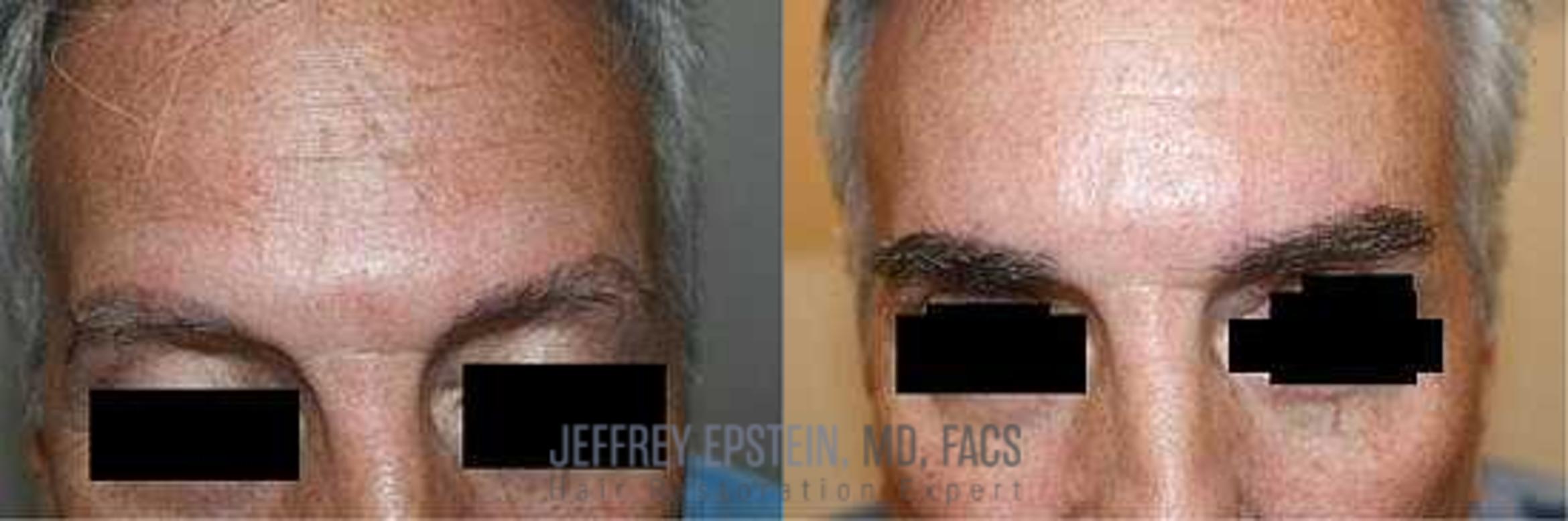 Before & After Eyebrow Transplant Case 298 View 3 View in Miami, FL