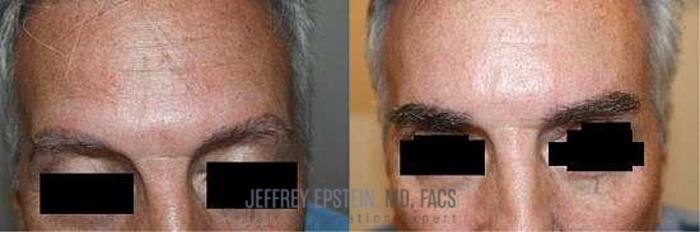 Before & After Eyebrow Transplant Case 298 View 3 View in Miami, FL