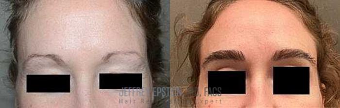 Before & After Eyebrow Transplant Case 299 View 1 View in Miami, FL