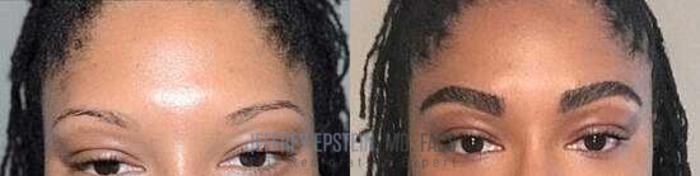 Before & After Eyebrow Transplant Case 300 View 1 View in Miami, FL