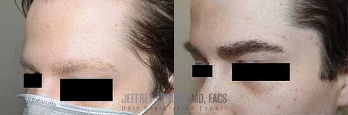 Before & After Eyebrow Transplant Case 301 View 2 View in Miami, FL