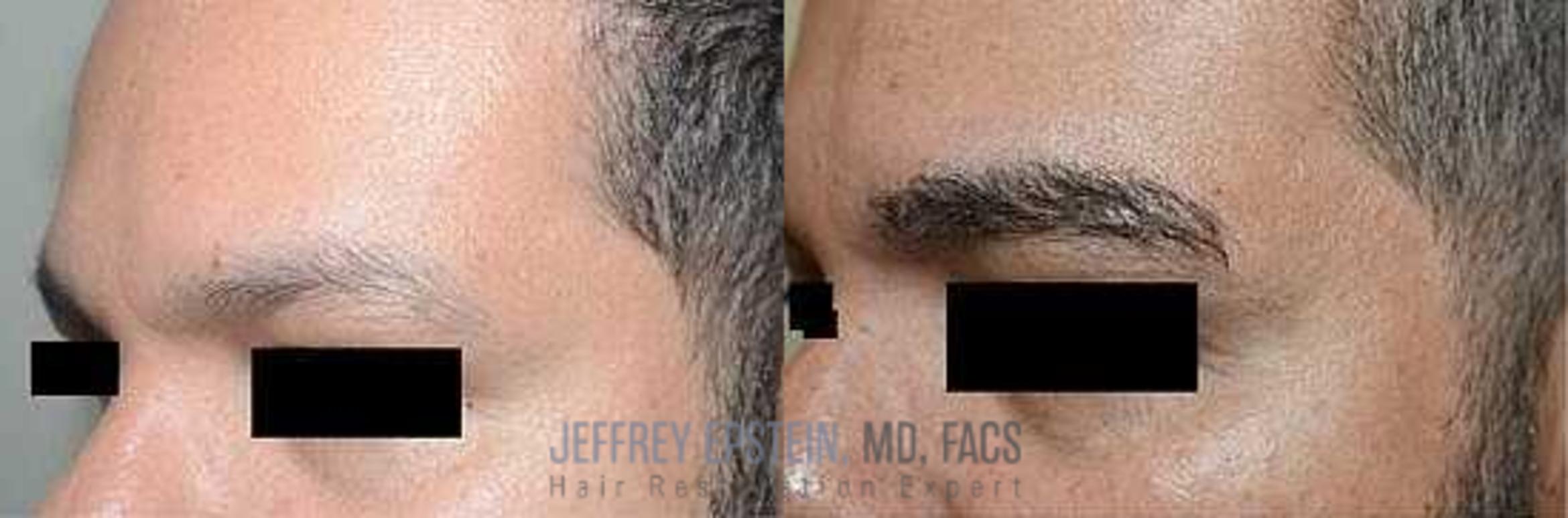 Before & After Eyebrow Transplant Case 302 View 1 View in Miami, FL