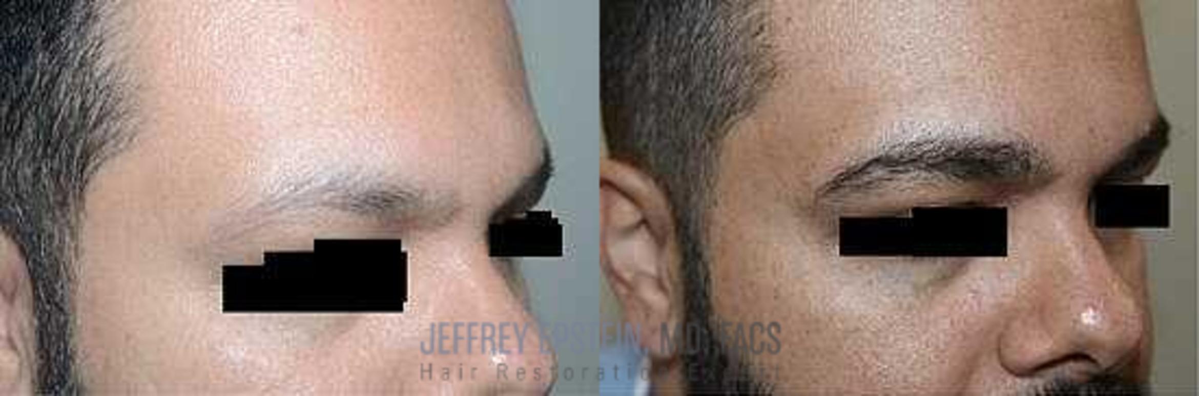 Before & After Eyebrow Transplant Case 302 View 2 View in Miami, FL