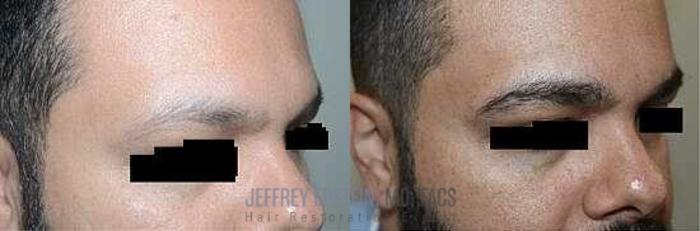 Before & After Eyebrow Transplant Case 302 View 2 View in Miami, FL