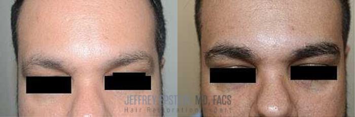 Before & After Eyebrow Transplant Case 302 View 3 View in Miami, FL