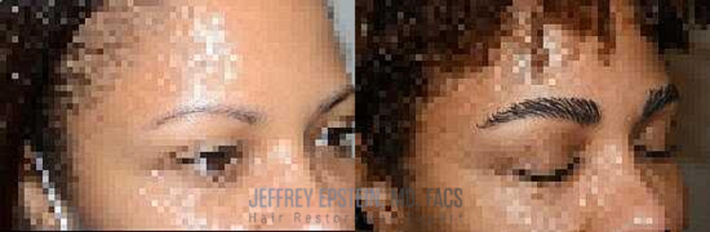 Before & After Eyebrow Transplant Case 303 View 2 View in Miami, FL
