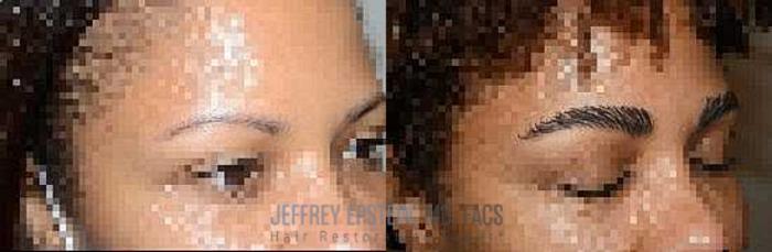 Before & After Eyebrow Transplant Case 303 View 2 View in Miami, FL