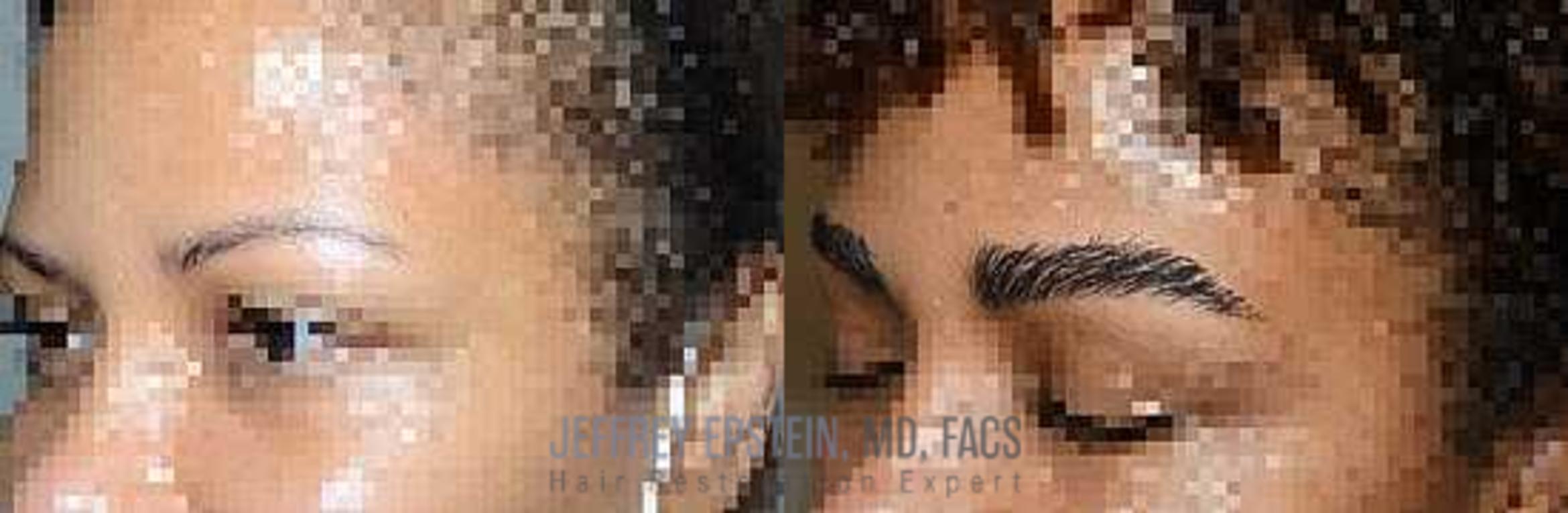 Before & After Eyebrow Transplant Case 303 View 3 View in Miami, FL