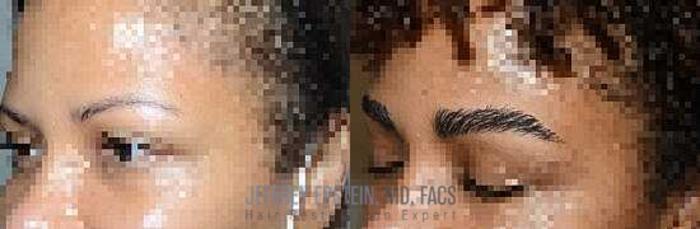 Before & After Eyebrow Transplant Case 303 View 3 View in Miami, FL