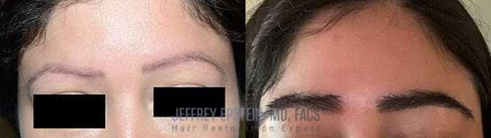 Before & After Eyebrow Transplant Case 304 View 1 View in Miami, FL