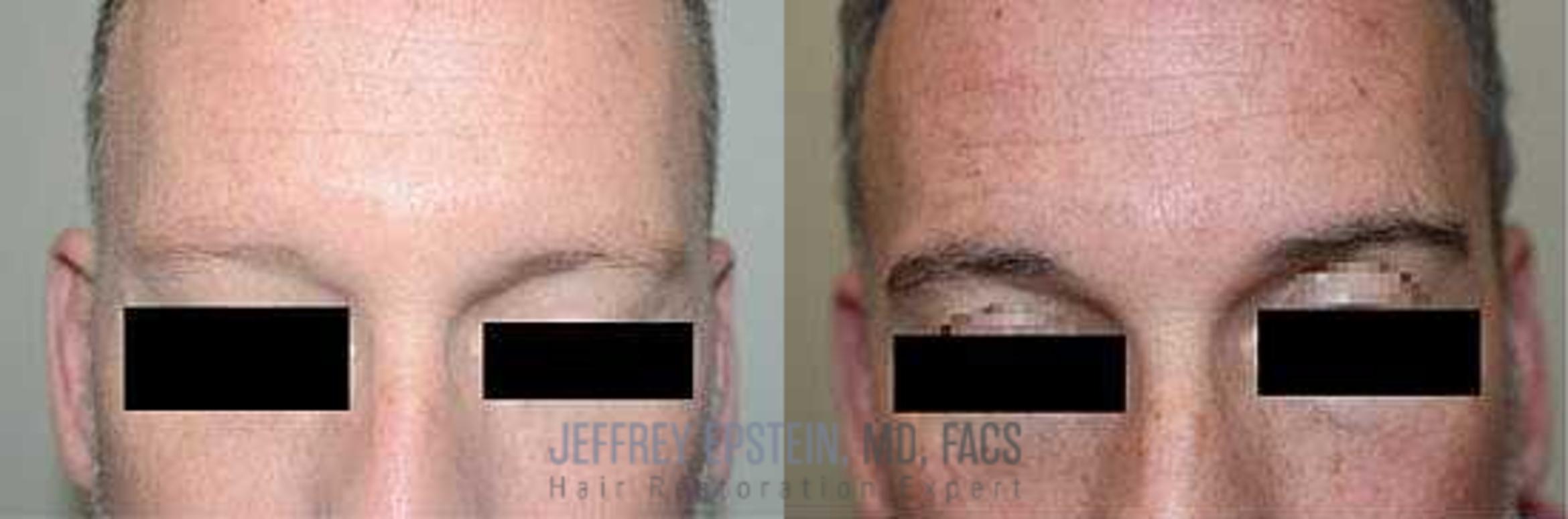 Before & After Eyebrow Transplant Case 305 View 1 View in Miami, FL