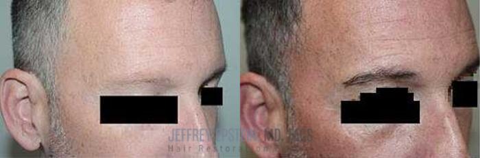 Before & After Eyebrow Transplant Case 305 View 2 View in Miami, FL