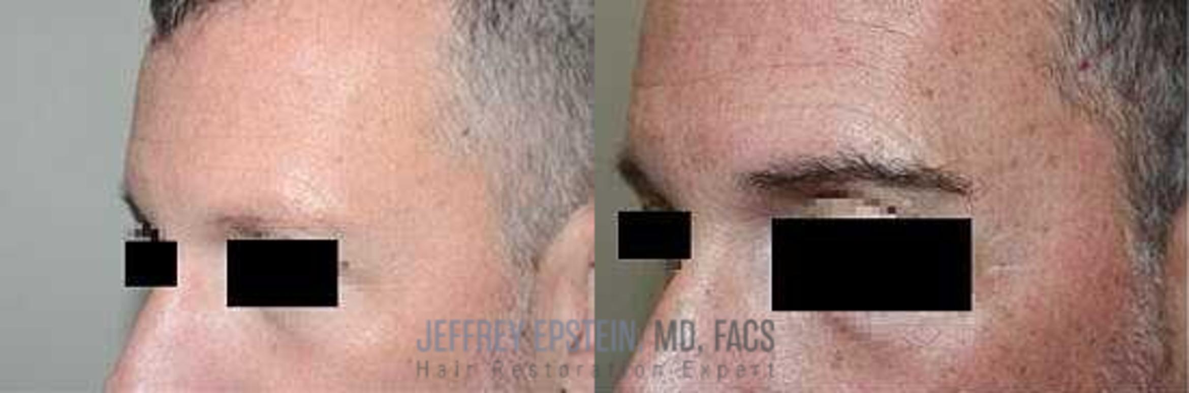 Before & After Eyebrow Transplant Case 305 View 3 View in Miami, FL