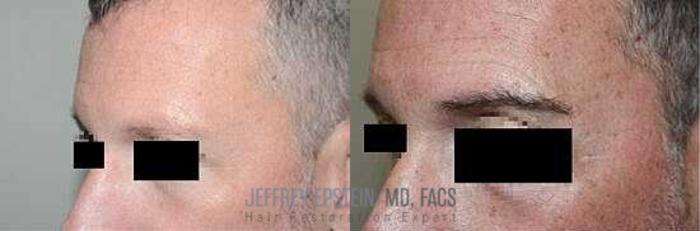 Before & After Eyebrow Transplant Case 305 View 3 View in Miami, FL