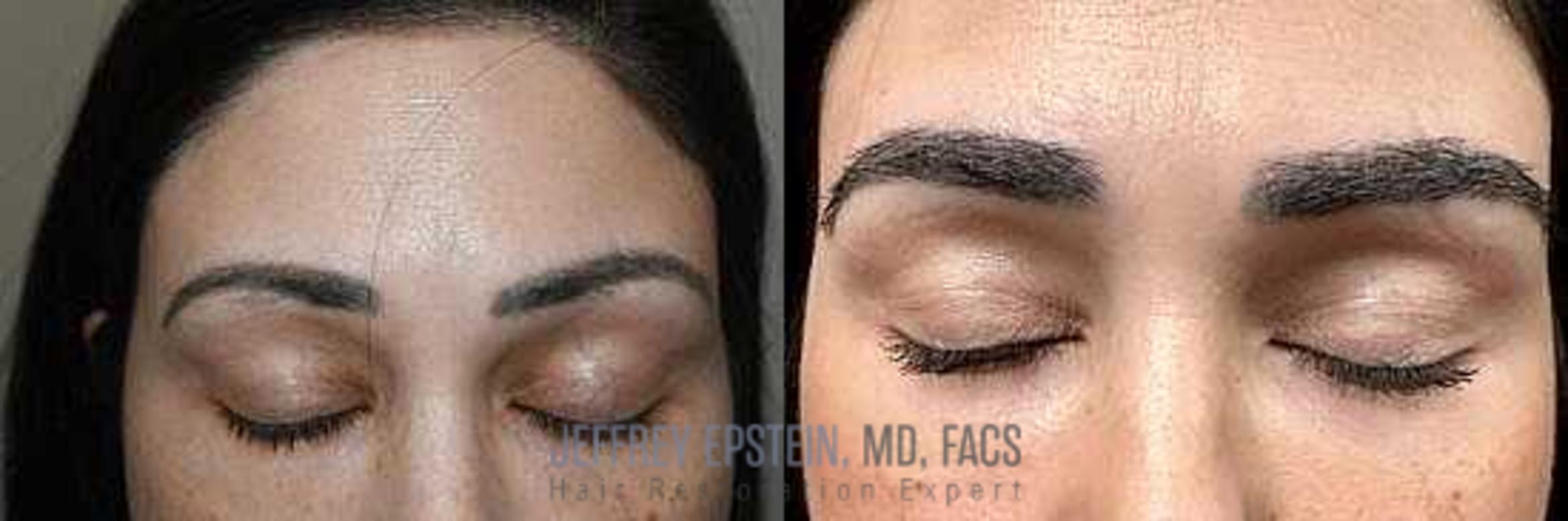 Before & After Eyebrow Transplant Case 306 View 1 View in Miami, FL