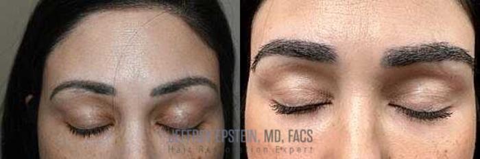 Before & After Eyebrow Transplant Case 306 View 1 View in Miami, FL
