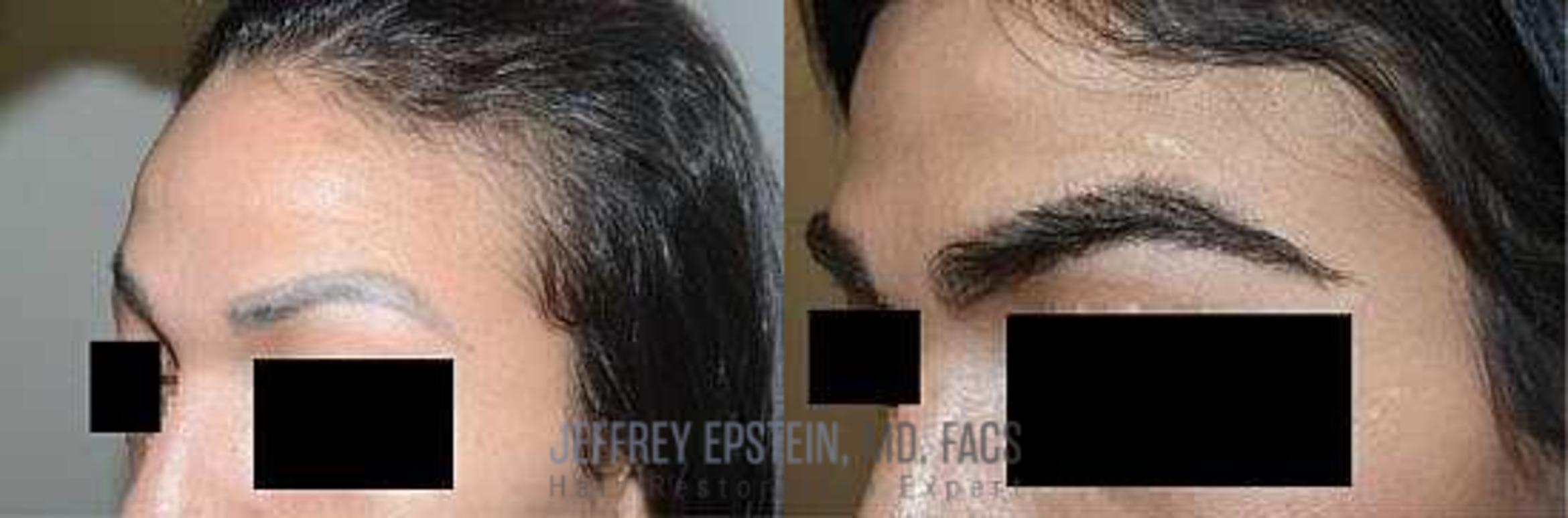 Before & After Eyebrow Transplant Case 307 View 1 View in Miami, FL