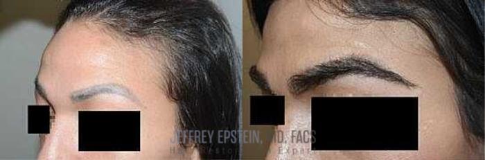 Before & After Eyebrow Transplant Case 307 View 1 View in Miami, FL