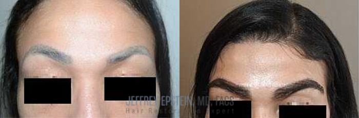 Before & After Eyebrow Transplant Case 307 View 2 View in Miami, FL