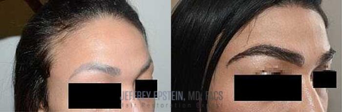 Before & After Eyebrow Transplant Case 307 View 3 View in Miami, FL