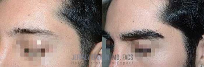 Before & After Eyebrow Transplant Case 308 View 2 View in Miami, FL