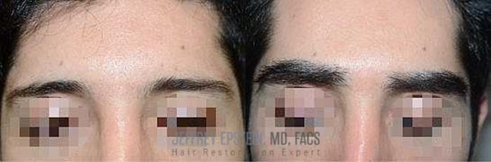 Before & After Eyebrow Transplant Case 308 View 3 View in Miami, FL