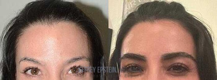 Before & After Eyebrow Transplant Case 309 View 1 View in Miami, FL