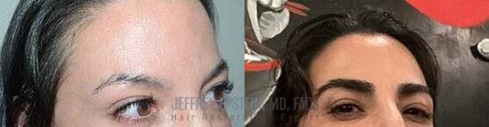 Before & After Eyebrow Transplant Case 309 View 2 View in Miami, FL