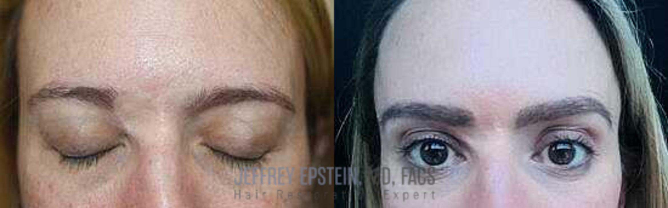 Before & After Eyebrow Transplant Case 310 View 1 View in Miami, FL