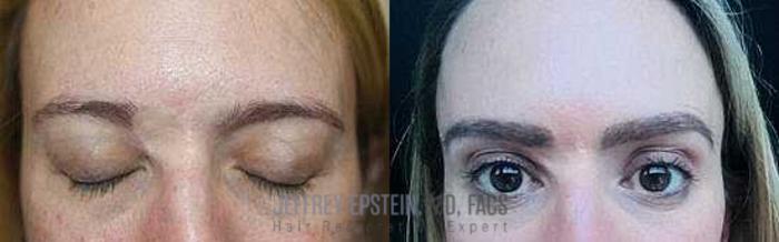 Before & After Eyebrow Transplant Case 310 View 1 View in Miami, FL
