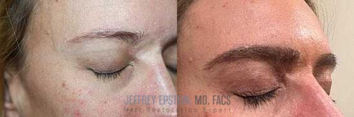 Before & After Eyebrow Transplant Case 310 View 2 View in Miami, FL