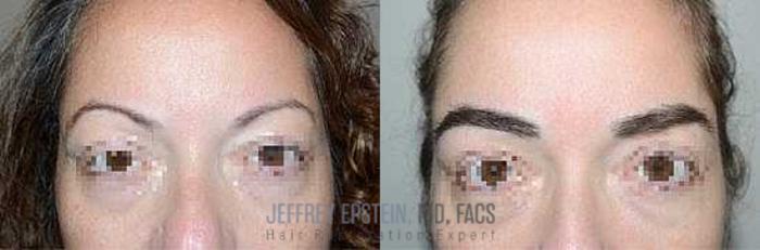 Before & After Eyebrow Transplant Case 311 View 1 View in Miami, FL