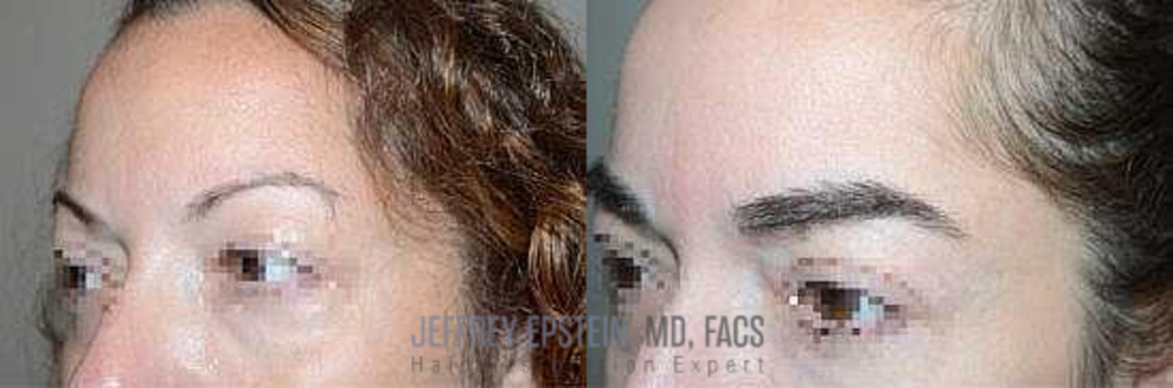 Before & After Eyebrow Transplant Case 311 View 2 View in Miami, FL