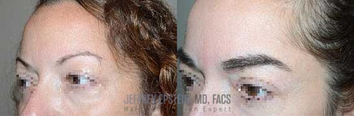 Before & After Eyebrow Transplant Case 311 View 2 View in Miami, FL