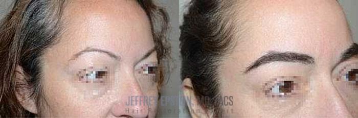 Before & After Eyebrow Transplant Case 311 View 3 View in Miami, FL