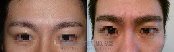 Before & After Eyebrow Transplant Case 312 View 1 View in Miami, FL