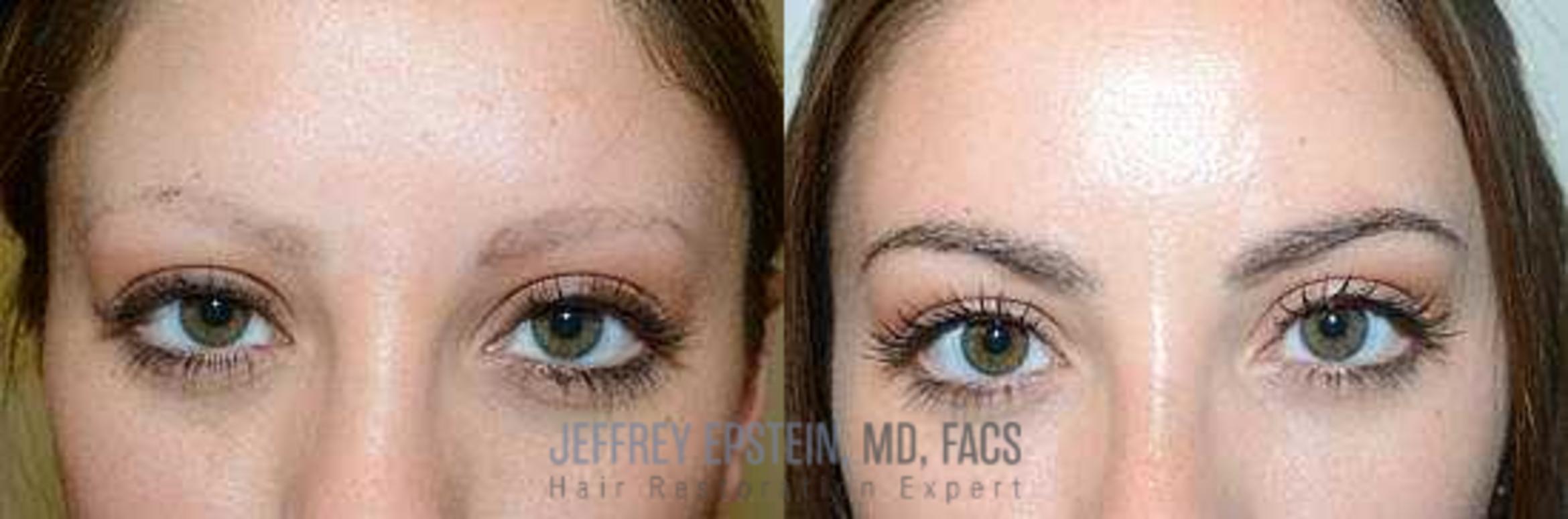 Before & After Eyebrow Transplant Case 313 View 1 View in Miami, FL