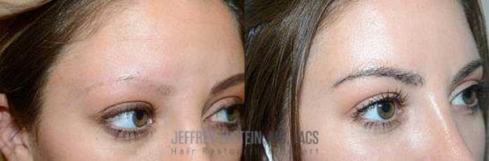 Before & After Eyebrow Transplant Case 313 View 2 View in Miami, FL