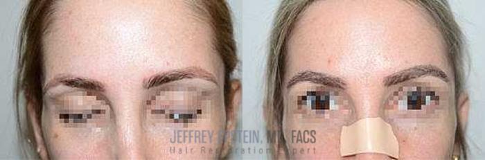 Before & After Eyebrow Transplant Case 314 View 1 View in Miami, FL