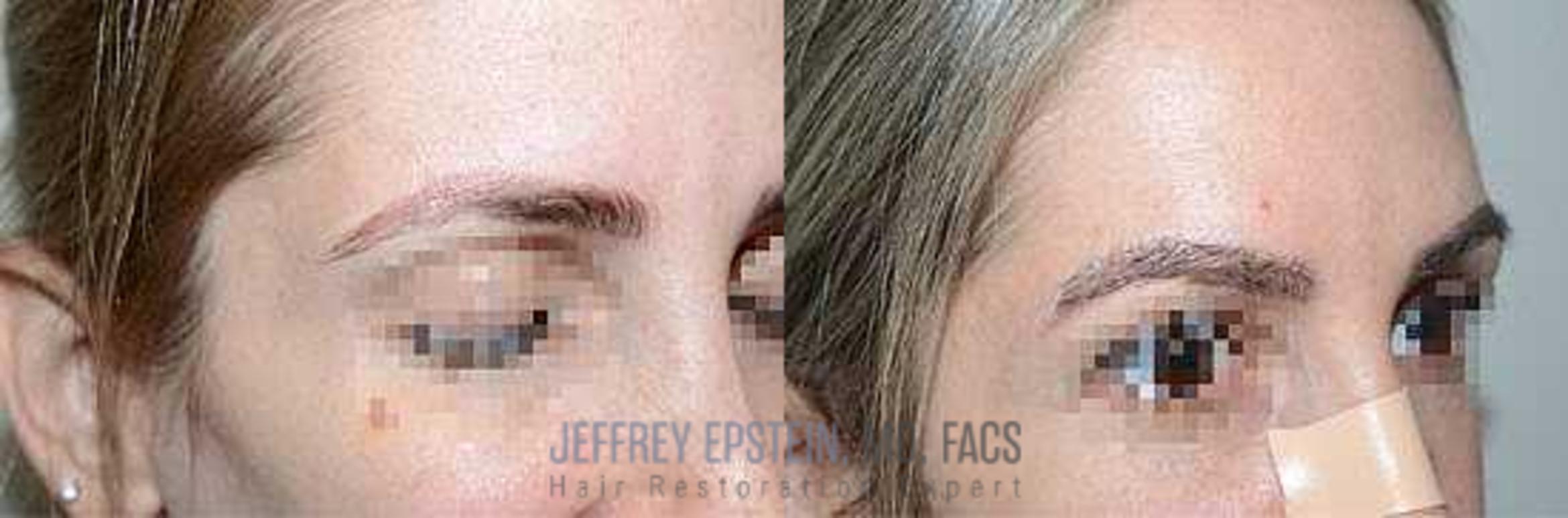 Before & After Eyebrow Transplant Case 314 View 2 View in Miami, FL