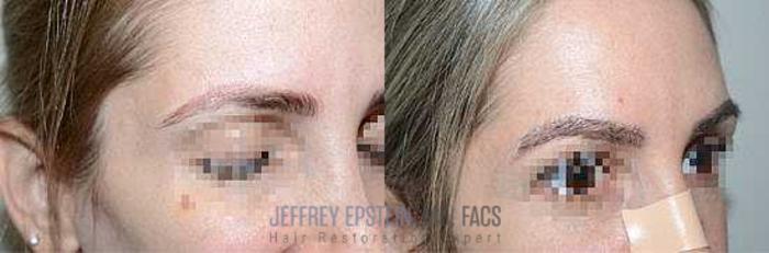 Before & After Eyebrow Transplant Case 314 View 2 View in Miami, FL