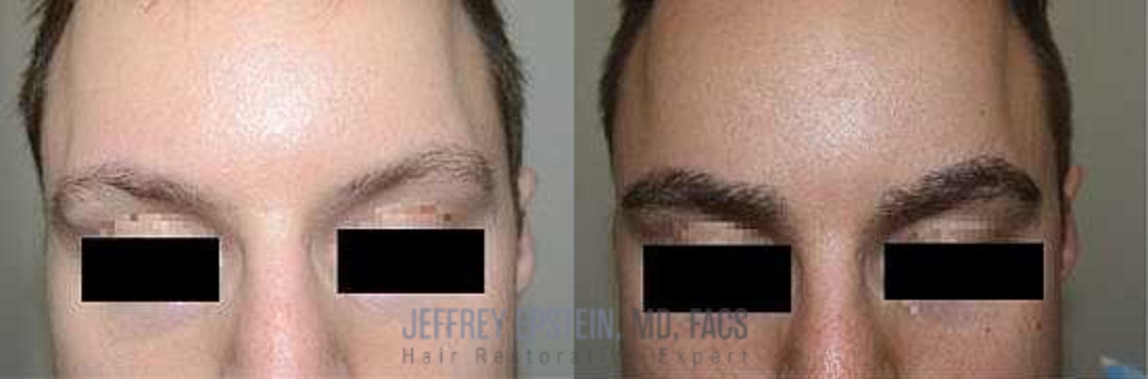 Before & After Eyebrow Transplant Case 315 View 1 View in Miami, FL